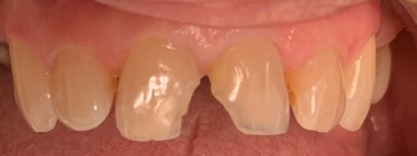 The image shows a close-up of upper front teeth with one missing tooth and another chipped in the middle.